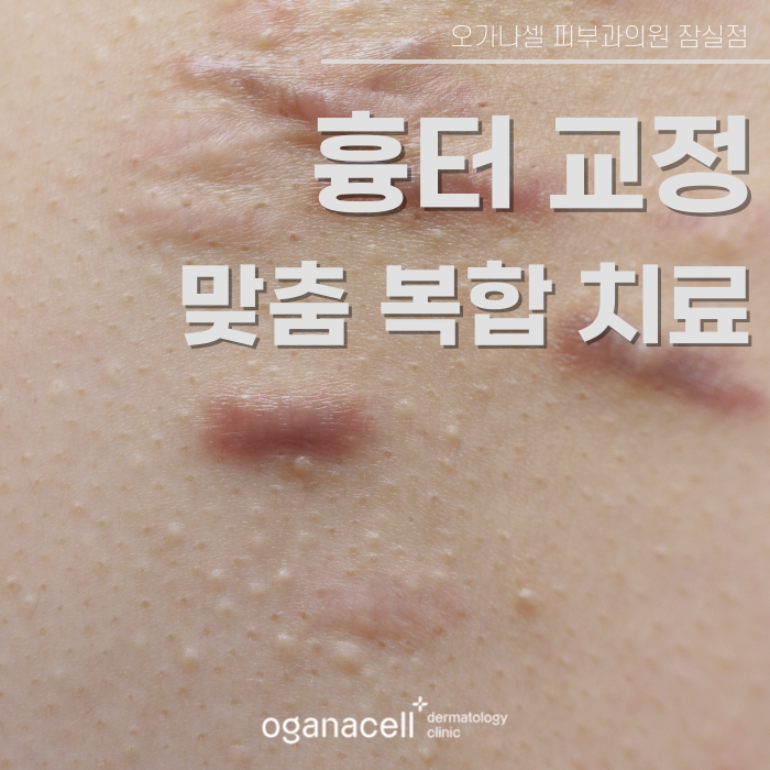 잠실흉터치료잘하는곳 오가나셀 관련 이미지 1