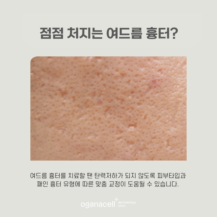 잠실흉터치료잘하는곳 오가나셀 관련 이미지 5
