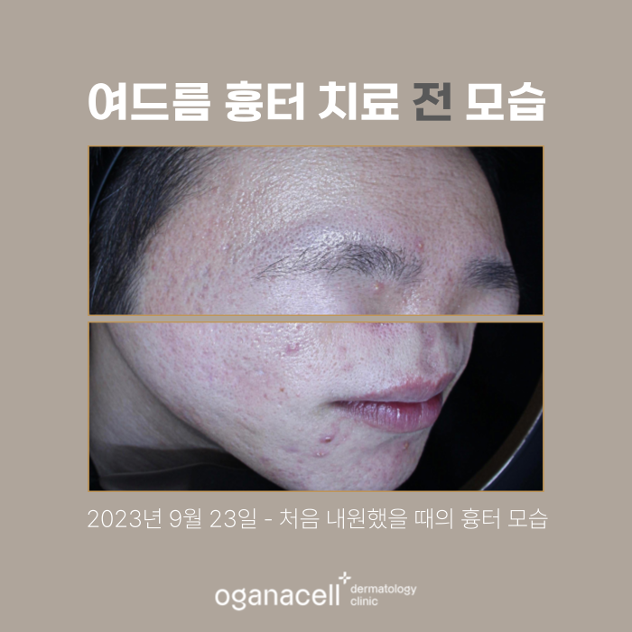 여드름 흉터 교정 20대 전후 비교 실제사례 관련 이미지 2