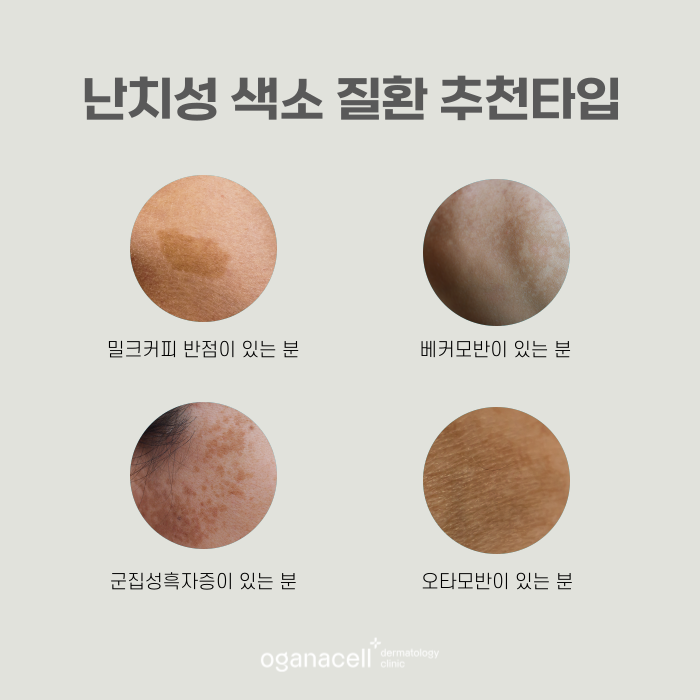 난치성색소질환 특징에 따른 맞춤 교정 관련 이미지 5