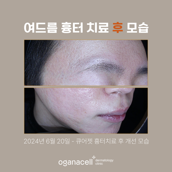 여드름 흉터 교정 20대 전후 비교 실제사례 관련 이미지 3