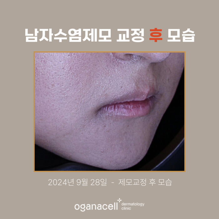 잠실 남자수염제모 피부과 관리 전후 비교 관련 이미지 3