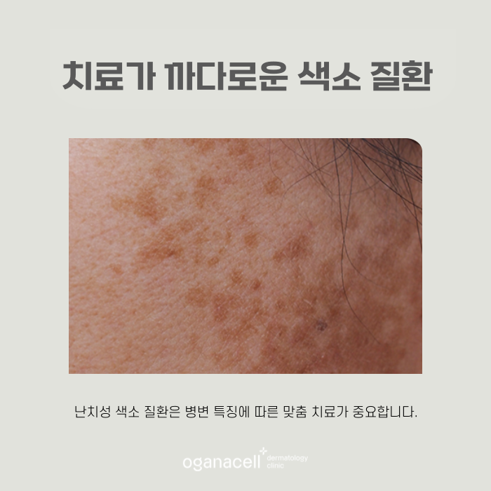 난치성색소질환 특징에 따른 맞춤 교정 관련 이미지 7