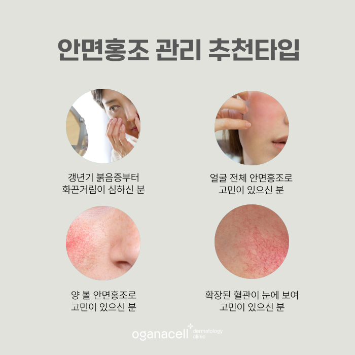 잠실 안면홍조 원인 알고 관리해야 하는 이유 관련 이미지 3