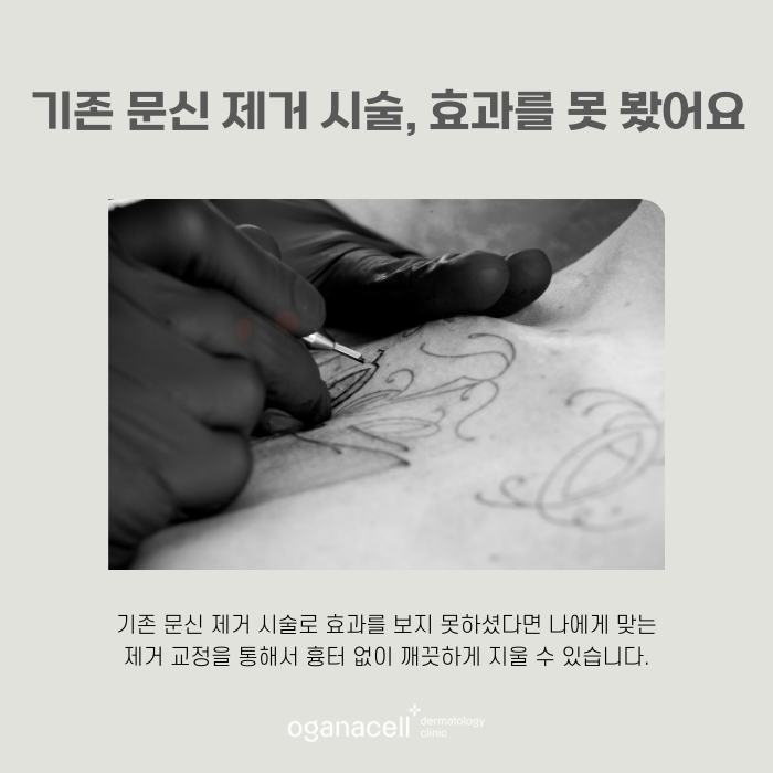 잠실역1번출구 문신제거 잘하는 곳 관련 이미지 5