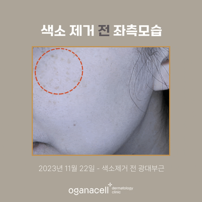 잠실색소제거 실제사례 전후 비교 관련 이미지 4