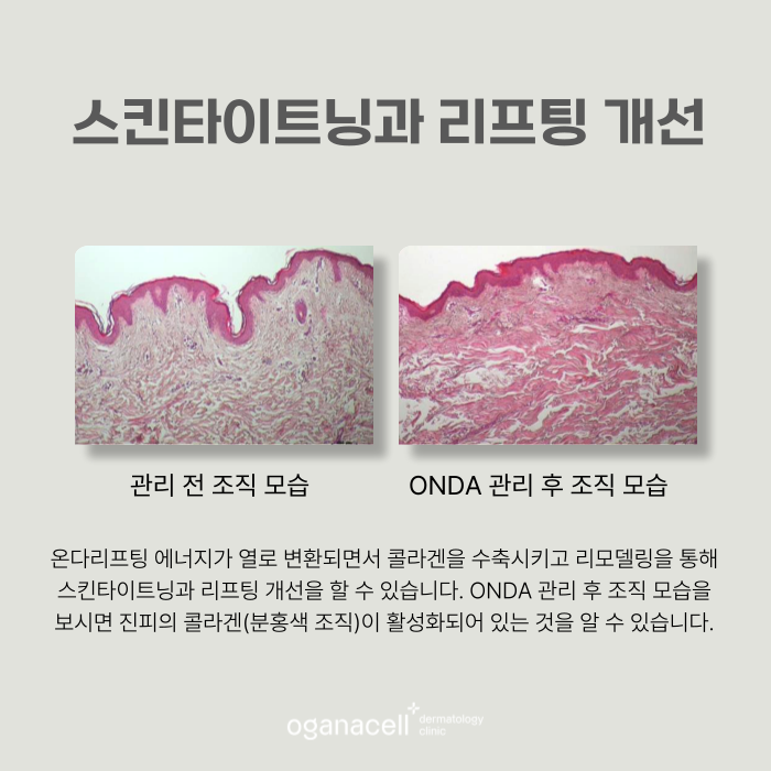 잠실온다리프팅 얼굴 바디 부위별 맞춤 관리팁 관련 이미지 7