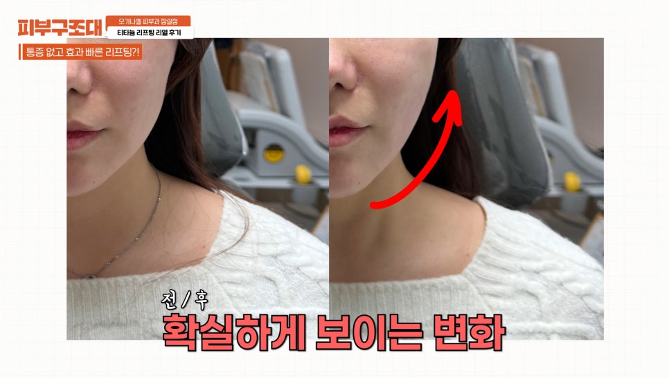 잠실새내 피부과 티타늄리프팅 주의사항 필독! 관련 이미지 12