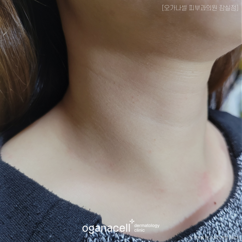 가로 세로 목주름 생기는 원인 등 알아볼게요 관련 이미지 5