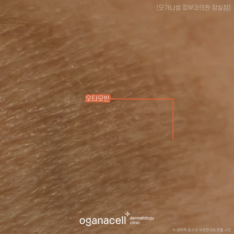 난치성 색소 치료 방법 밀크커피반점, 베커모반, 군집성흑자증, 오타모반 의심될 때 관련 이미지 5