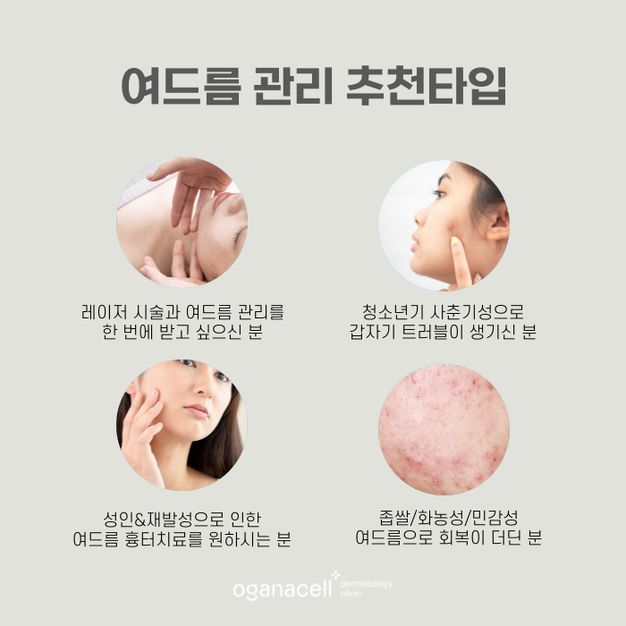 사춘기성 등 여드름압출잘하는곳 잠실피부과 관련 이미지 5