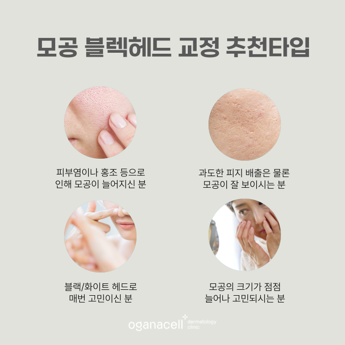 코의피지 제거하는 방법 원인부터 개선해야 관련 이미지 3