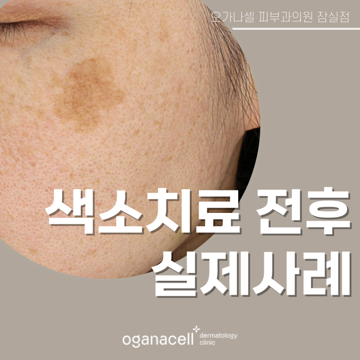 잠실피부과 색소 교정 실제사례 전후 비교 관련 이미지 1