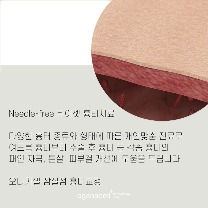 큐어젯 흉터 잠실역에 잘하는 곳 관련 이미지 8