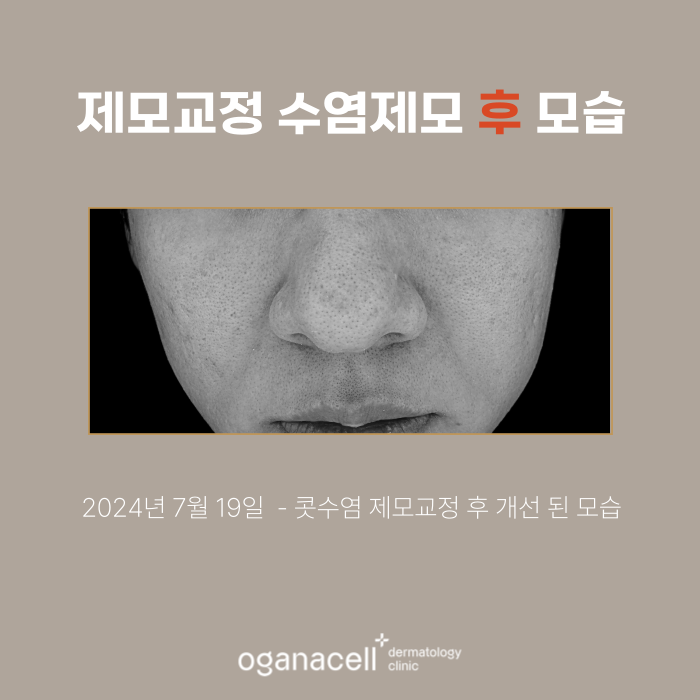 남자수염제모 전후 비교 실제사례 관련 이미지 3