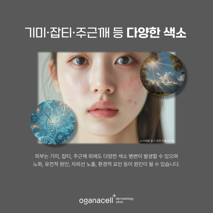 잠실역 피부과 - 기미, 색소침착 원인부터 예방 방법 관련 이미지 4