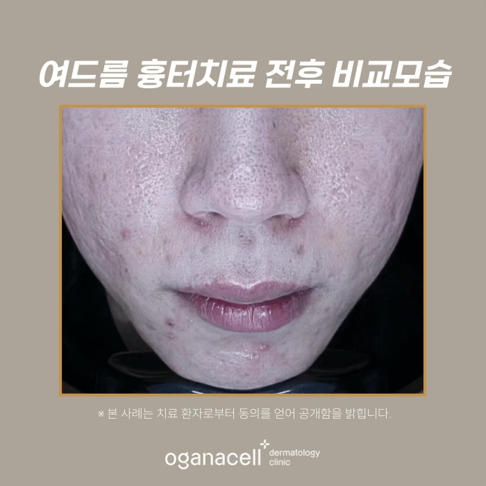 여드름 흉터 교정 20대 전후 비교 실제사례 관련 이미지 4