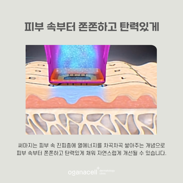 잠실 써마지 4세대가 좋은 이유 관련 이미지 6