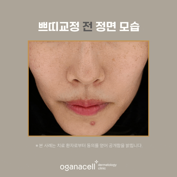 잠실역 스컬트라 관리 실제사례 후기 관련 이미지 6
