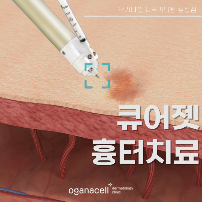 큐어젯 흉터 잠실역에 잘하는 곳 관련 이미지 1