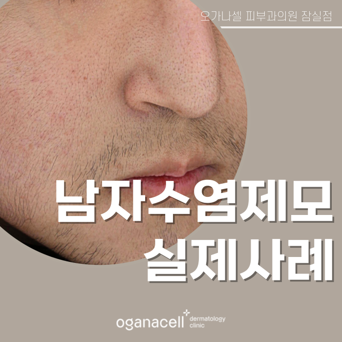 잠실 남자수염제모 피부과 관리 전후 비교 관련 이미지 1