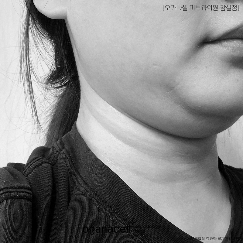 얼굴리프팅 내게 맞는 방법은? 관련 이미지 3