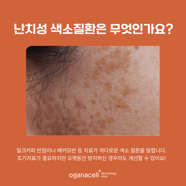 난치성 색소 주의사항 알아야 하는 이유 관련 이미지 4