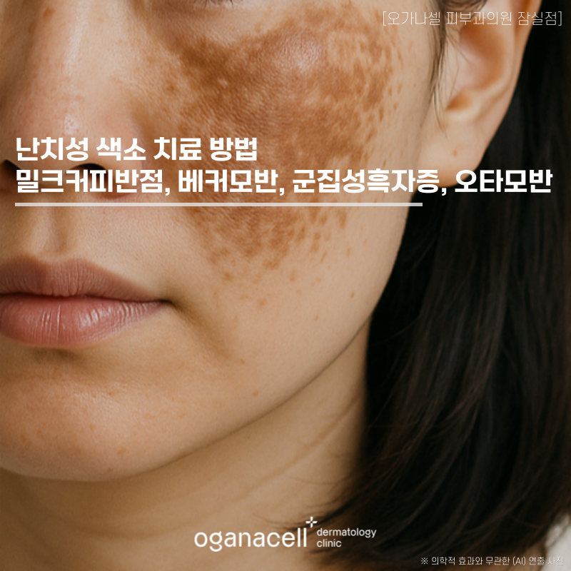 난치성 색소 치료 방법 밀크커피반점, 베커모반, 군집성흑자증, 오타모반 의심될 때 관련 이미지 1