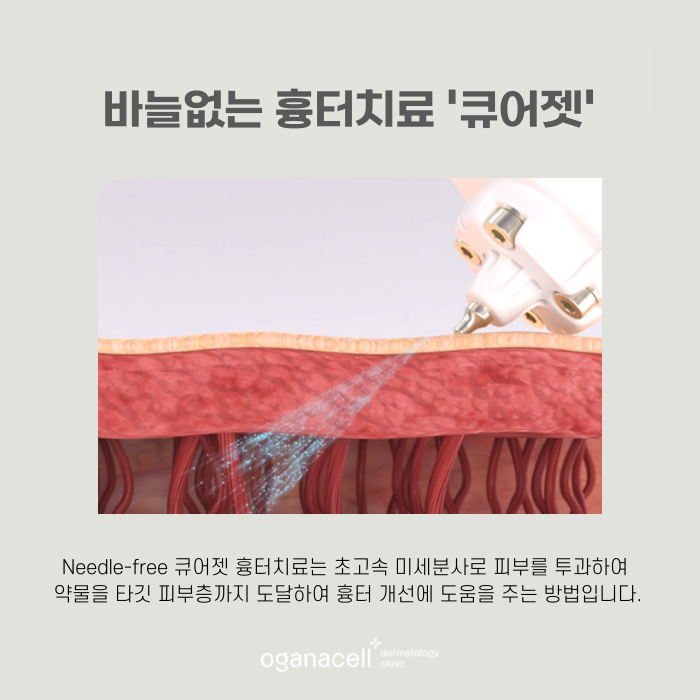잠실새내 흉터치료 큐어젯 하는 곳 관련 이미지 5