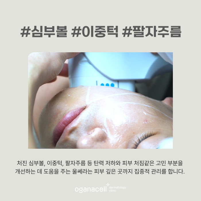 잠실울쎄라 퍼스널 케어로 유지기간을 오래 관련 이미지 5