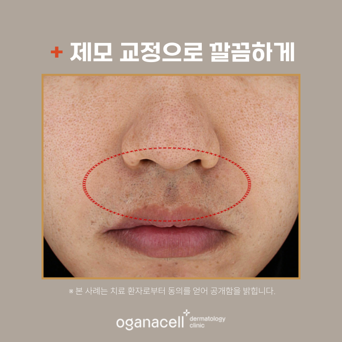 잠실피부과 기미 색소 제거 실제 후기 관련 이미지 5