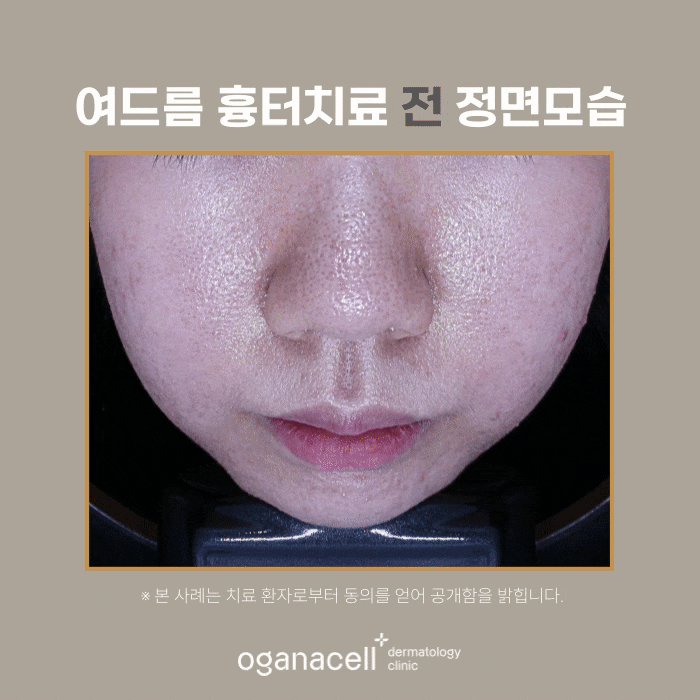 성인여드름 제거 후기 전후 비교 실제사례 관련 이미지 5
