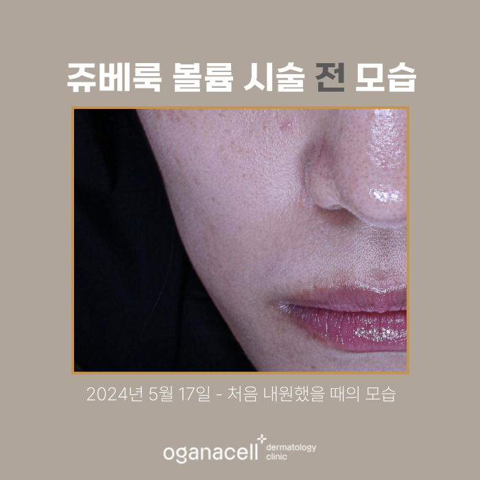 잠실쥬베룩볼륨 전후 비교 실제사례 관련 이미지 2