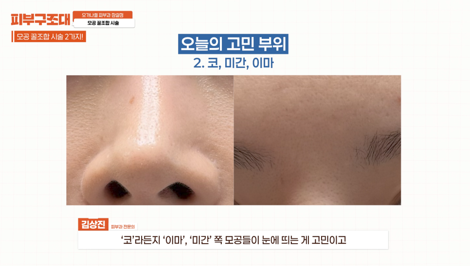 모공 포텐자, 함께 받으면 좋은 잠실피부과 관리 1가지 관련 이미지 3