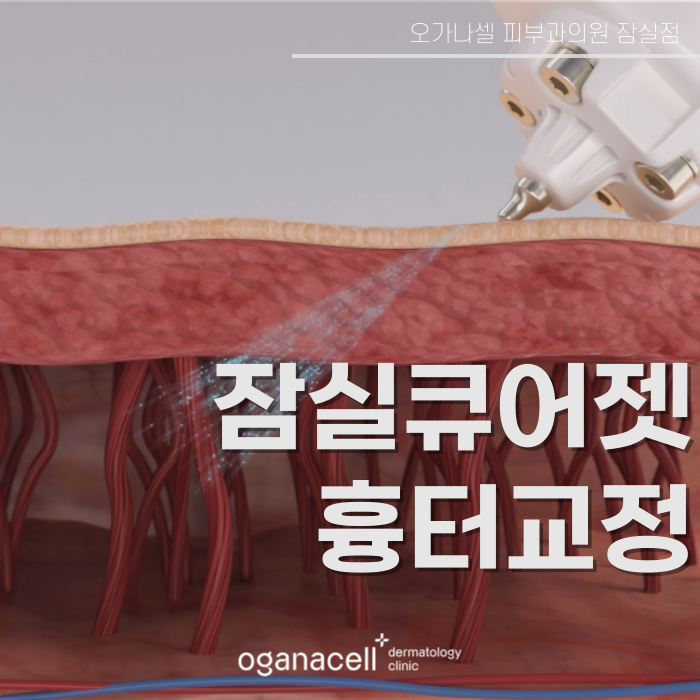 잠실큐어젯 흉터교정 방법 관련 이미지 1