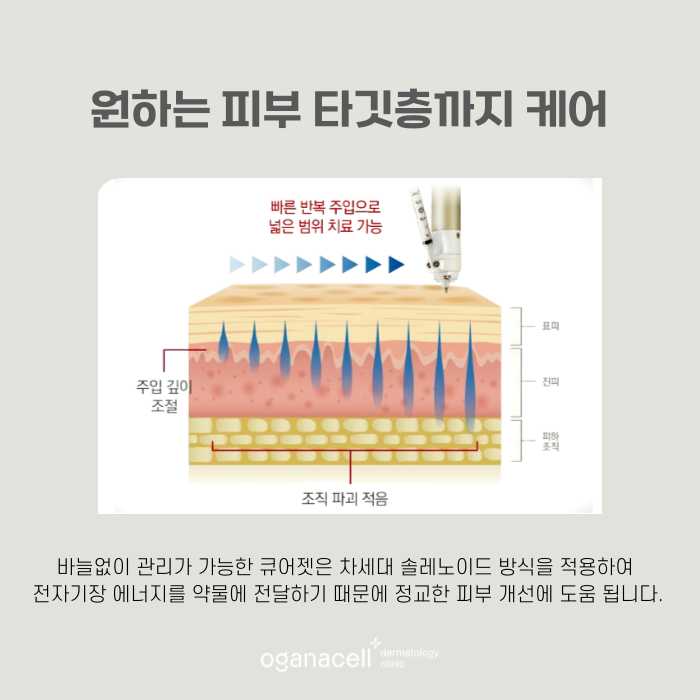 흉터 큐어젯 잠실역피부과 관련 이미지 4