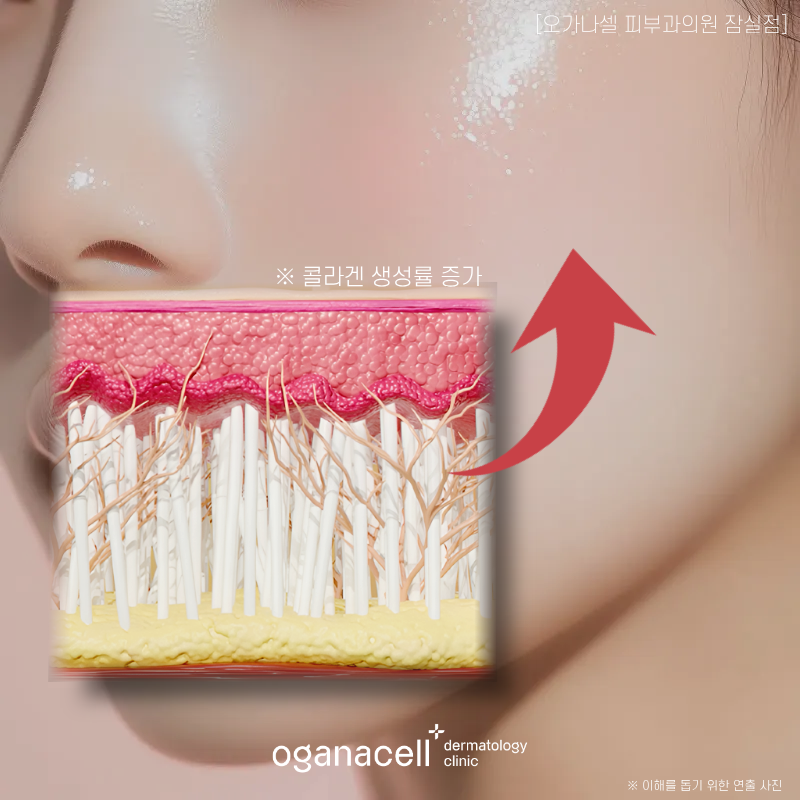 잠실 스킨부스터 한 번으로 피부개선 된 사례(고우리) 관련 이미지 3