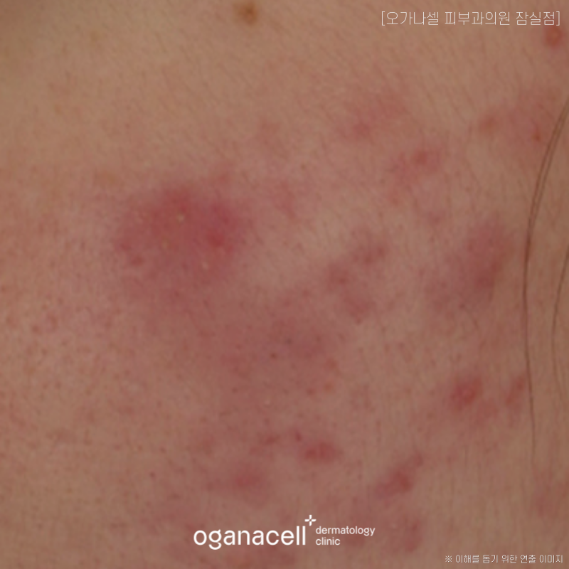 How to Care for Acne Scars, Step by Step Without Irritation image 2