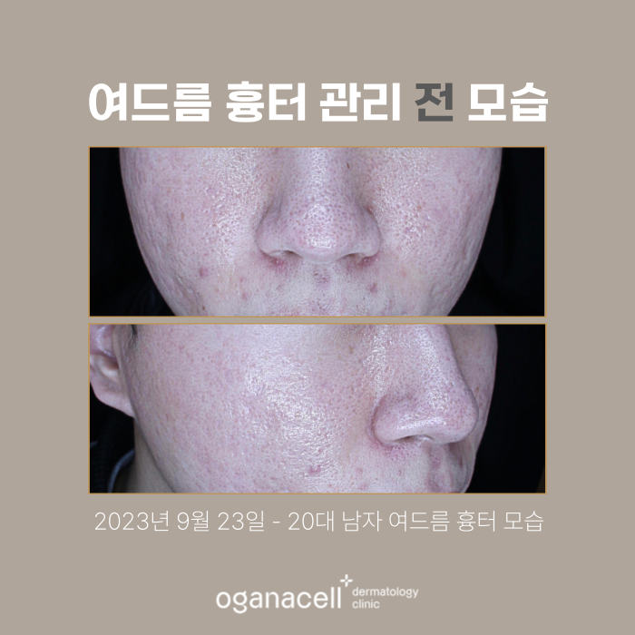 남자여드름피부 잠실피부과 흉터교정 전후 비교 관련 이미지 2