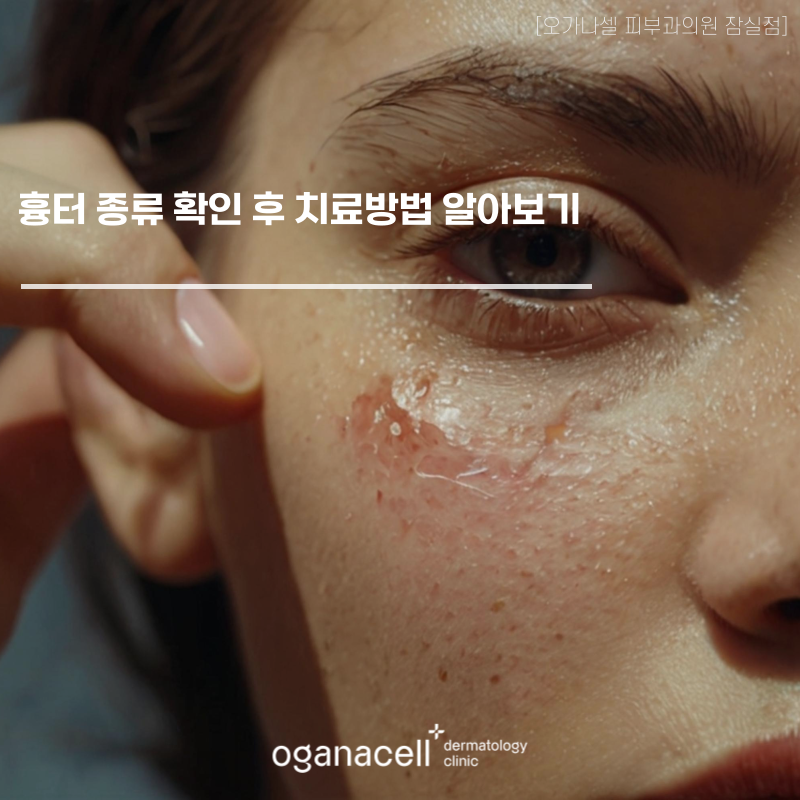 흉터제거 하기 전에 종류 확인 후 치료방법 알아보기 관련 이미지 1