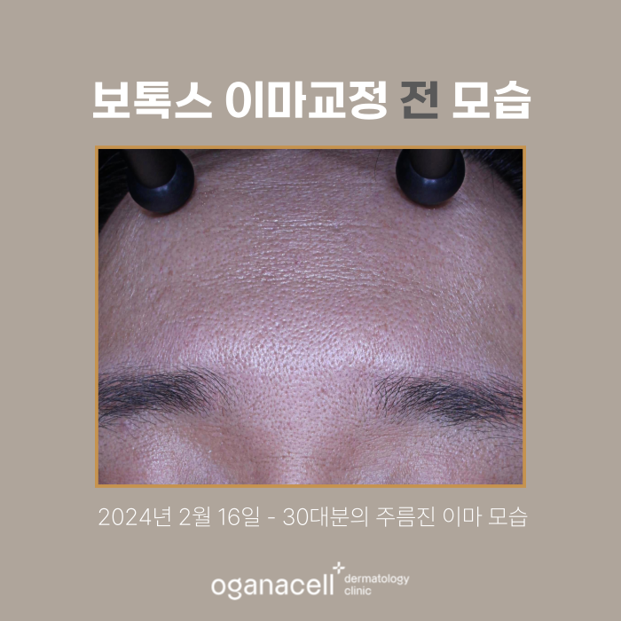 잠실보톡스 이마 쁘띠교정 전후 모습 비교 관련 이미지 2