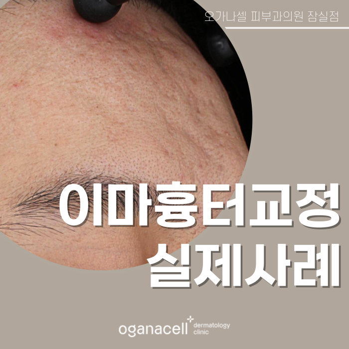 Forehead Scar Correction: Actual Case Before and After Comparison image 1