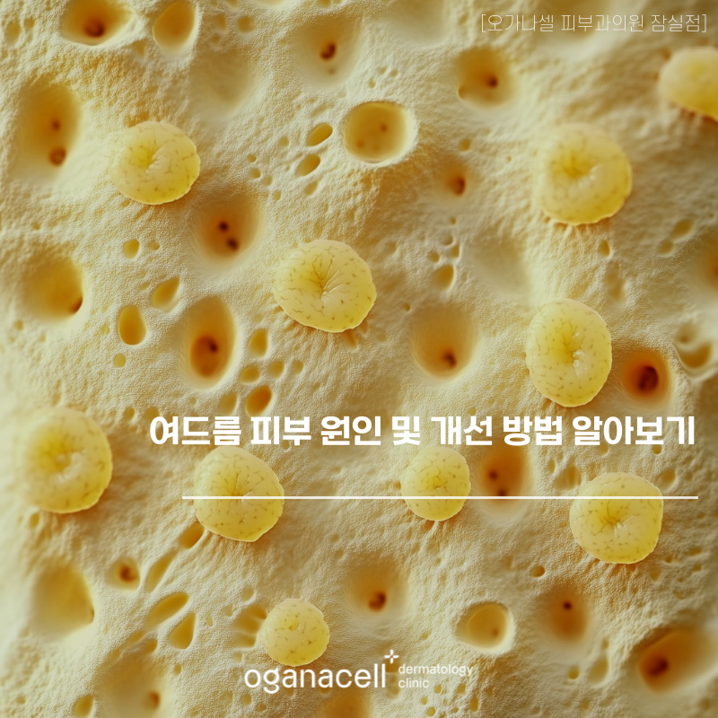 여드름 피부 원인 및 개선 방법 알아보기 관련 이미지 1