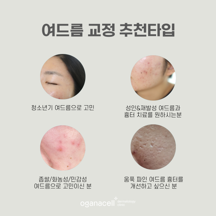 얼굴 트러블 원인 제거해서 해결해 주는 잠실피부과 관련 이미지 5