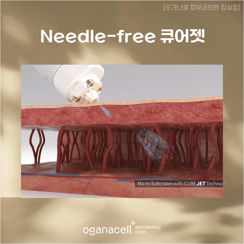 잠실여드름피부과, 큐어젯을 알려드리는 이유 관련 이미지 6
