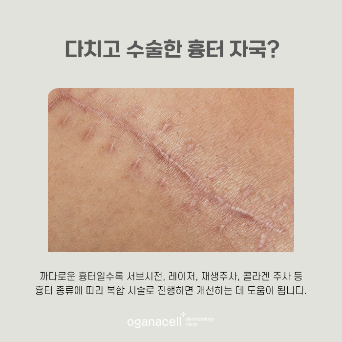잠실흉터치료잘하는곳 오가나셀 관련 이미지 6