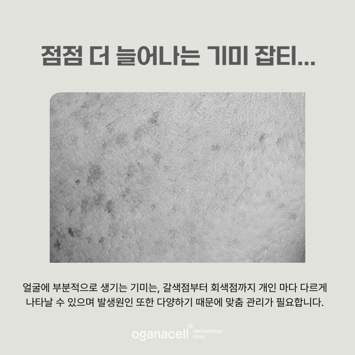 얼굴 갈색점 알고보면 기미일 수 있어요 관련 이미지 5
