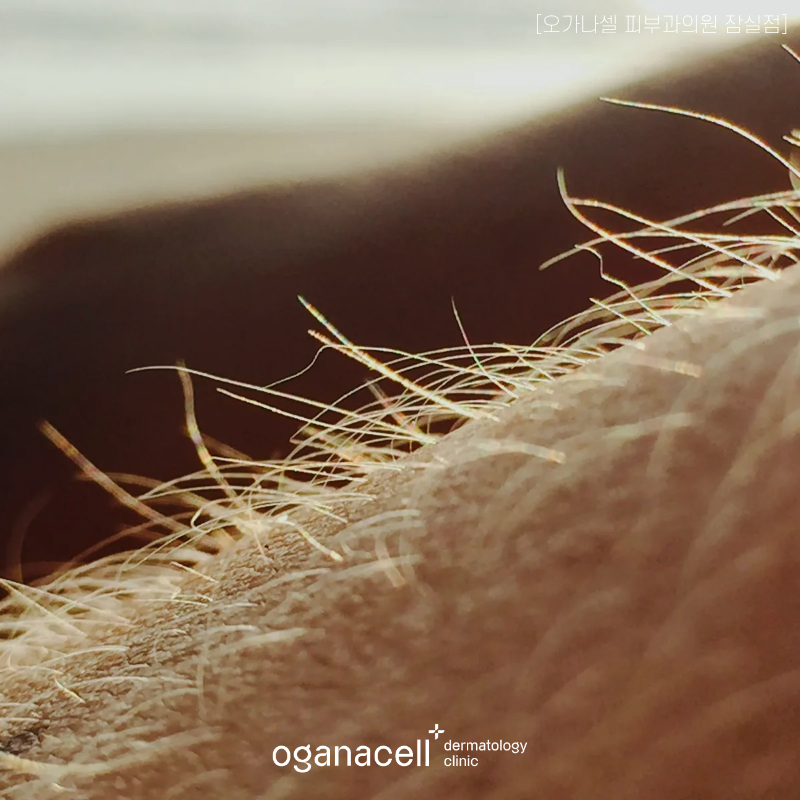 Jamsil Hair Removal Dermatology: Worried About Underarm Odor? Have a Lot of Hair? image 5