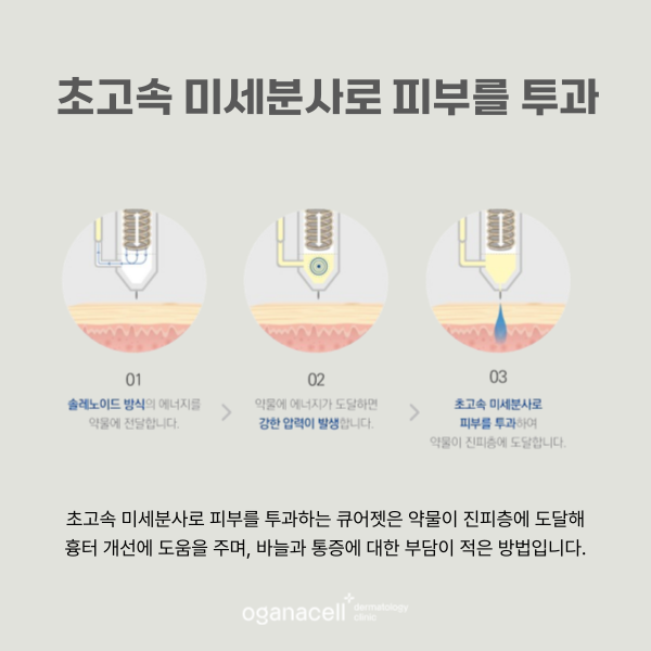 흉터 안 아프게 없애는 법 관련 이미지 5