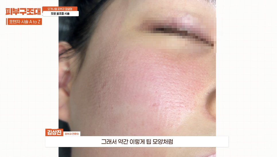 모공 포텐자, 함께 받으면 좋은 잠실피부과 관리 1가지 관련 이미지 9